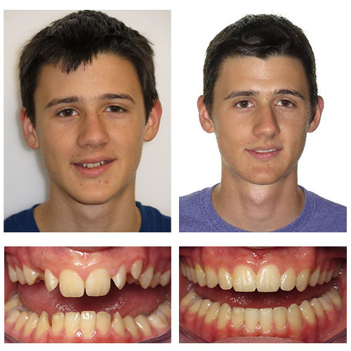 Before and After Misuraca Orthodontics Baton Rouge Prairieville